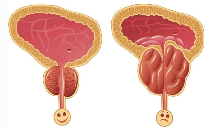 Est-ce que le cancer de la prostate se soigne ?