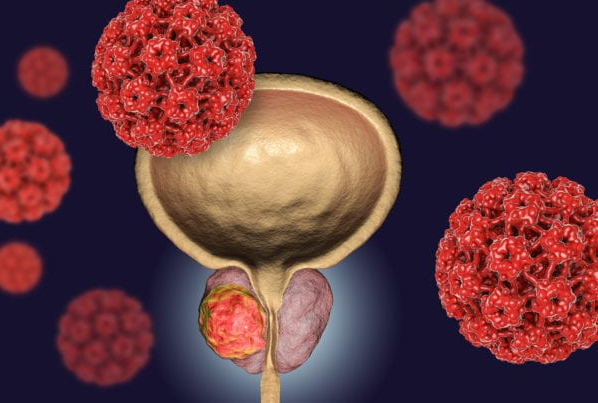 Quel est le pourcentage de guérison d'un cancer de la prostate ?