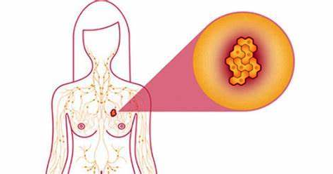 Où apparaît le cancer du sein ?
