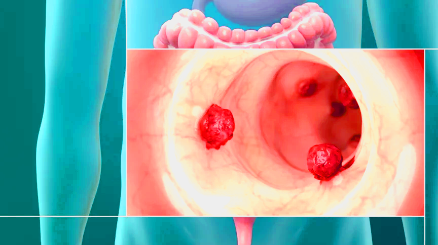 Comment sont les selles quand on a un cancer du côlon ?