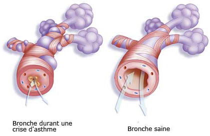 les signes d'une asthmatique