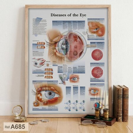 Tableau Ophtalmologie Maladies de l'œil : Décoration Murale Professionnelle anatomie la cataracte - decor Cabinets & bureau médecin au Maroc, Casablanca.