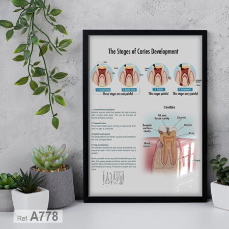 Affiche Éducative en anglais : Stades du Développement de la Carie, Tableau decor cabinet, les quatre étapes du développement de la carie dentaire, vendu au Maroc